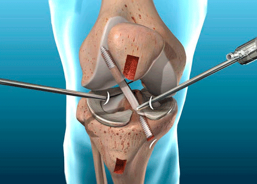 Artroscopia para tratar lesiones en las articulaciones